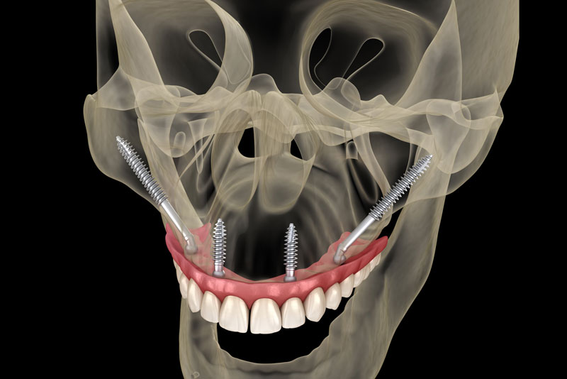 Things To Expect From Zygomatic Dental Implants In Hopkins, MN