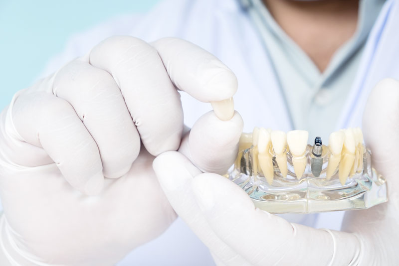 Can Anyone Have A Temporary Prosthesis Placed After Having Dental Implant Surgery?